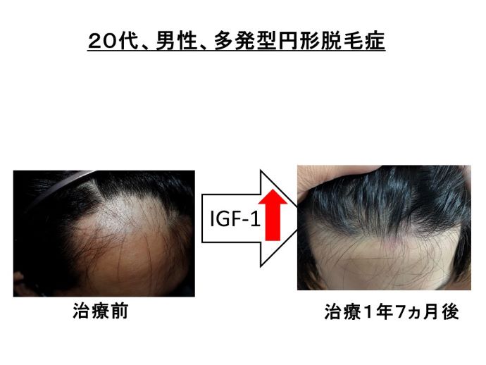 円形脱毛症　病院